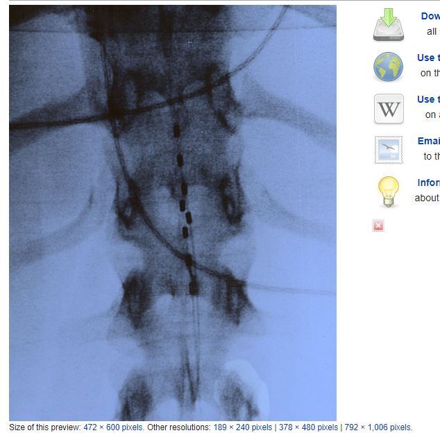 Epidural Stimulation | SPINALpedia